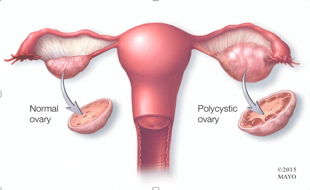 pcos